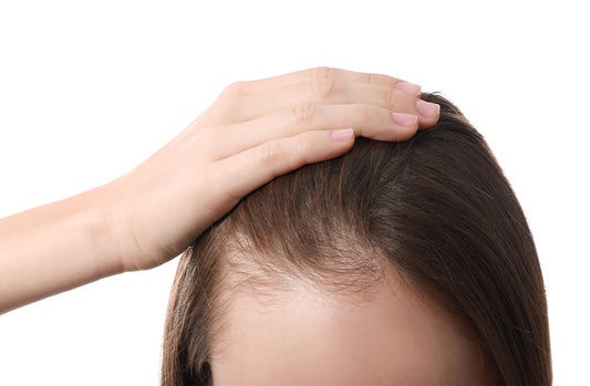 All About Traction Alopecia